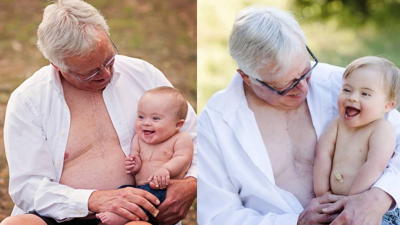 Grandpa & Grandson Share Special Bond Through Their Scars